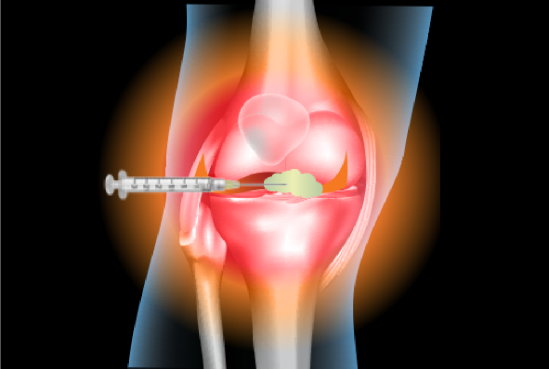 Illustration showing knee injection missing the correct site