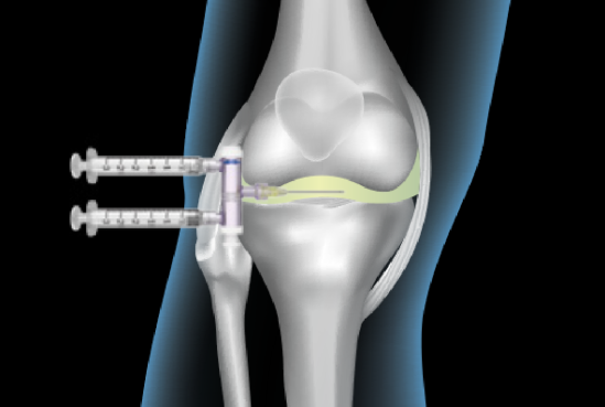 Illustration showing successful knee injection with A-TAP